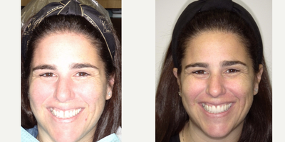 Porcelain Veneers before and after photo