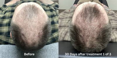PRP for Hair Loss before and after photo