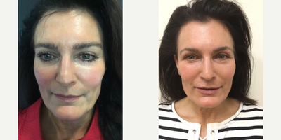 Skin Tightening before and after photo