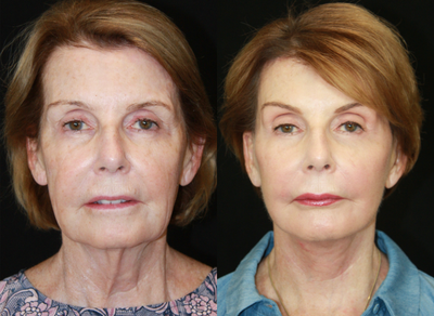 Facelift before and after photo