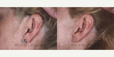 Facelift before and after photo