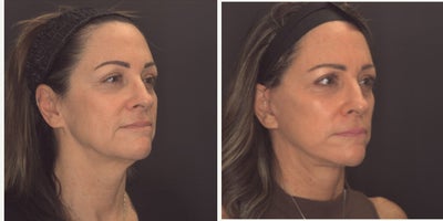 Facelift before and after photo