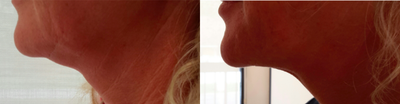 Kybella before and after photo