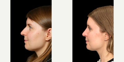 Rhinoplasty before and after photo
