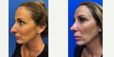 Rhinoplasty before and after photo