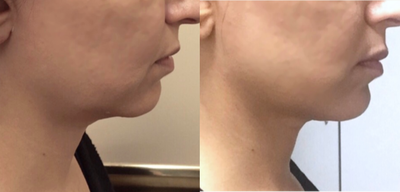 Ultherapy before and after photo