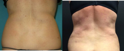 Vaser Liposuction before and after photo