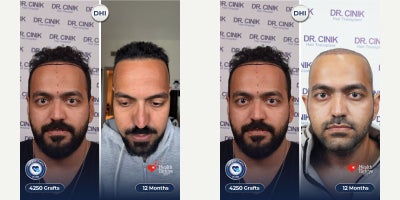 DHI Hair Transplant before and after photo