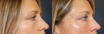Juvederm before and after photo