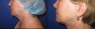 Liposuction before and after photo