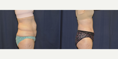 Liposuction before and after photo