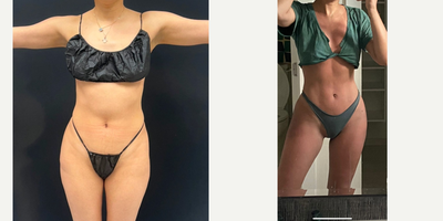 Abdominal Etching before and after photo