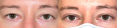 Eyelid Surgery before and after photo
