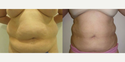 Liposuction before and after photo