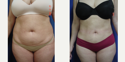 Liposuction before and after photo