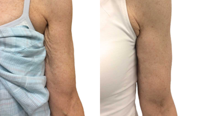 Vollure before and after photo