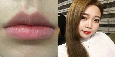 Botox before and after photo