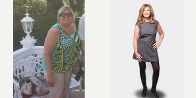Gastric Sleeve Surgery before and after photo