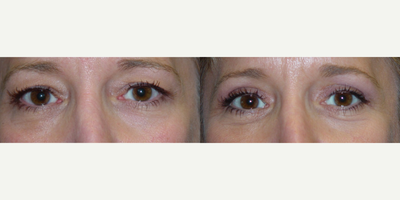 LASIK before and after photo