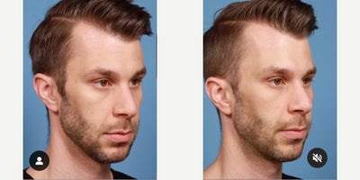 PRF Treatment before and after photo