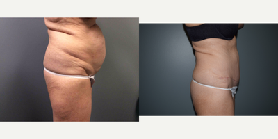 Tummy Tuck before and after photo
