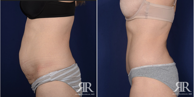Body Lift before and after photo