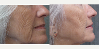 Exilis before and after photo