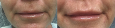 Lip Fillers before and after photo