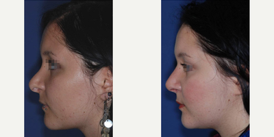 Revision Rhinoplasty before and after photo