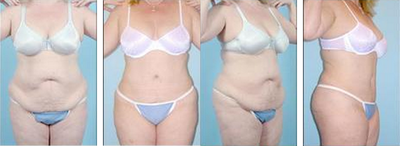 Tummy Tuck before and after photo