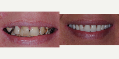 All-on-4 Dental Implants before and after photo