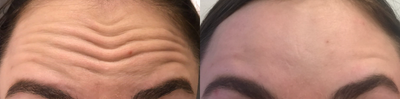 Botox before and after photo