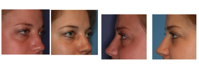 Eyelid Surgery before and after photo