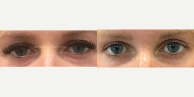 Eyelid Surgery before and after photo