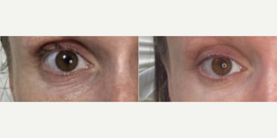 Eyelid Surgery before and after photo