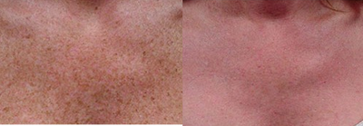 IPL before and after photo