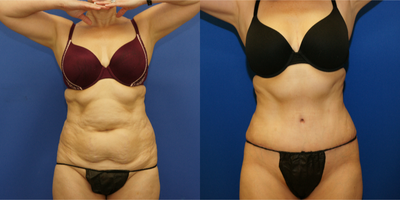 Tummy Tuck before and after photo