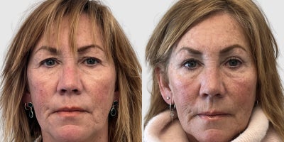 Eyelid Surgery before and after photo