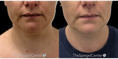 Neck Lift before and after photo