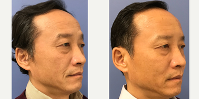 Radiesse before and after photo