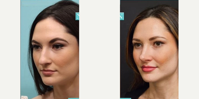 Rhinoplasty before and after photo