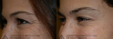 Botox before and after photo