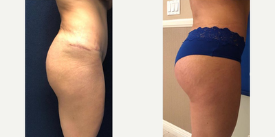 Butt Augmentation before and after photo
