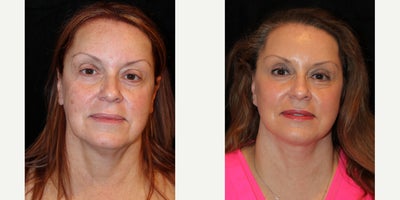 Eyelid Surgery before and after photo