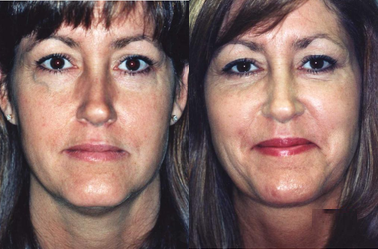 Facelift before and after photo