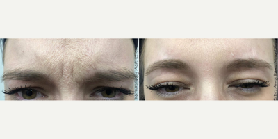 Jeuveau before and after photo