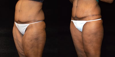 Body Lift before and after photo