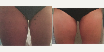 Brazilian Butt Lift before and after photo