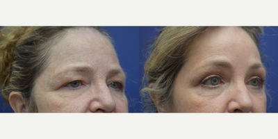 Brow Lift before and after photo