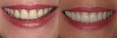 Dental Crown before and after photo